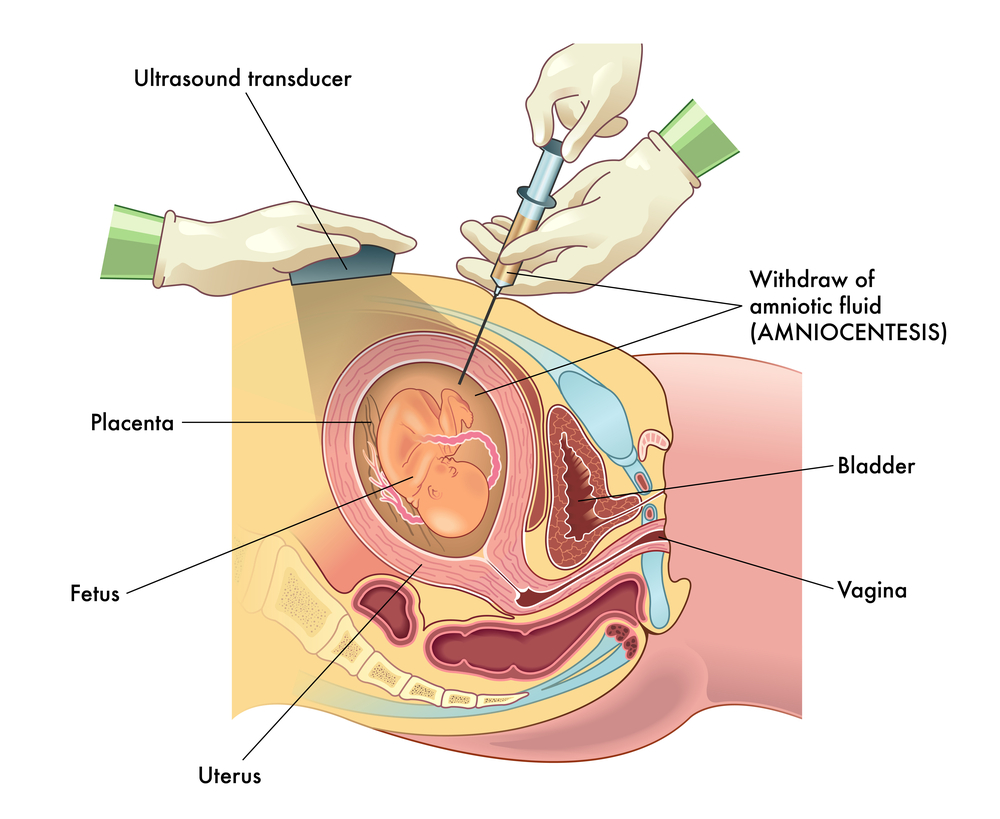 Amniocentesis procedure