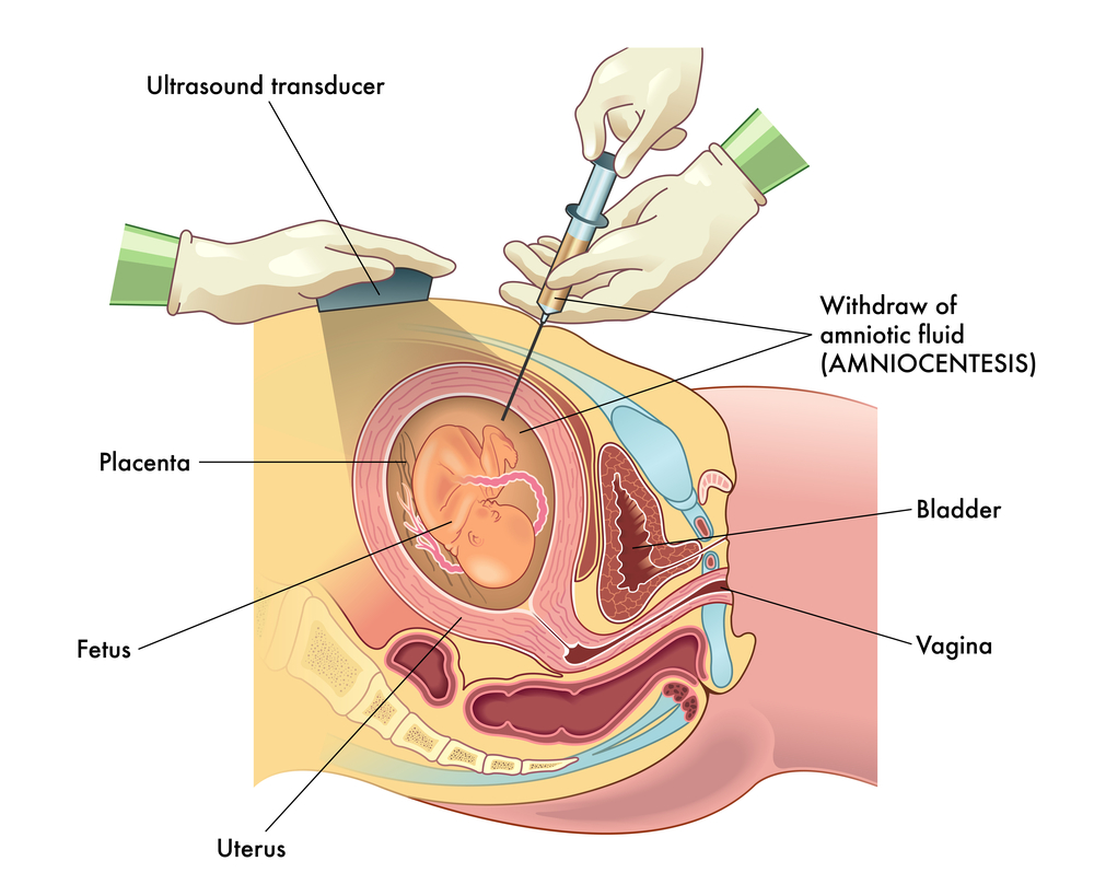amniocentesi come si fa
